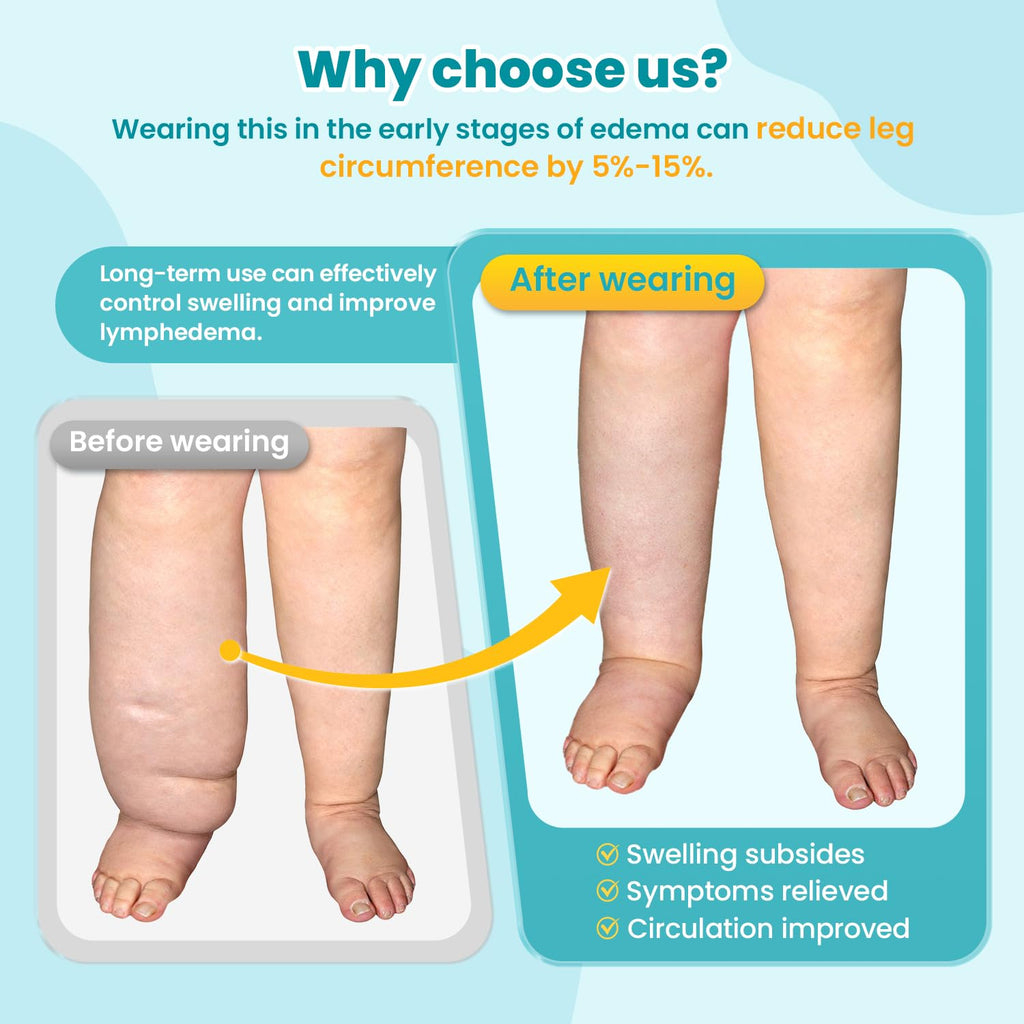Sylong Swelling Edema Compression Wrap Adjustable Sleeve for Lower Leg Lymphedema

