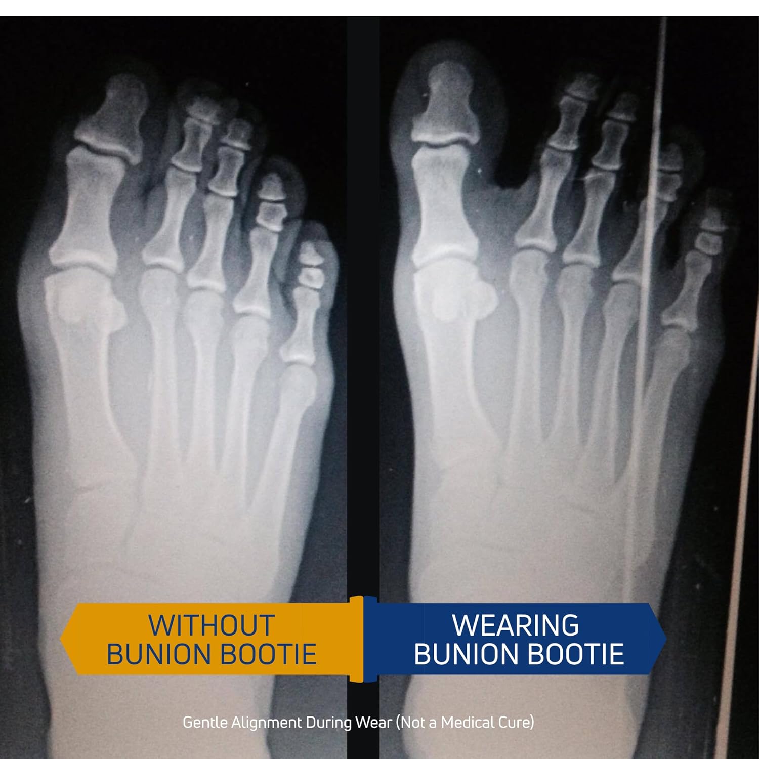 Bunion Corrector for Women Big Toe Straightener, Ultra-Thin Shoe-Friendly Sock

