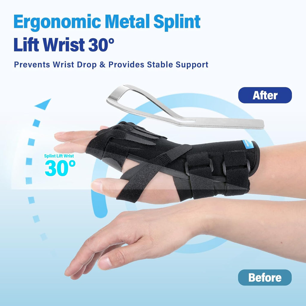 Chonario Radial Nerve Palsy Splint for Wrist Drop, Finger Extension Brace

