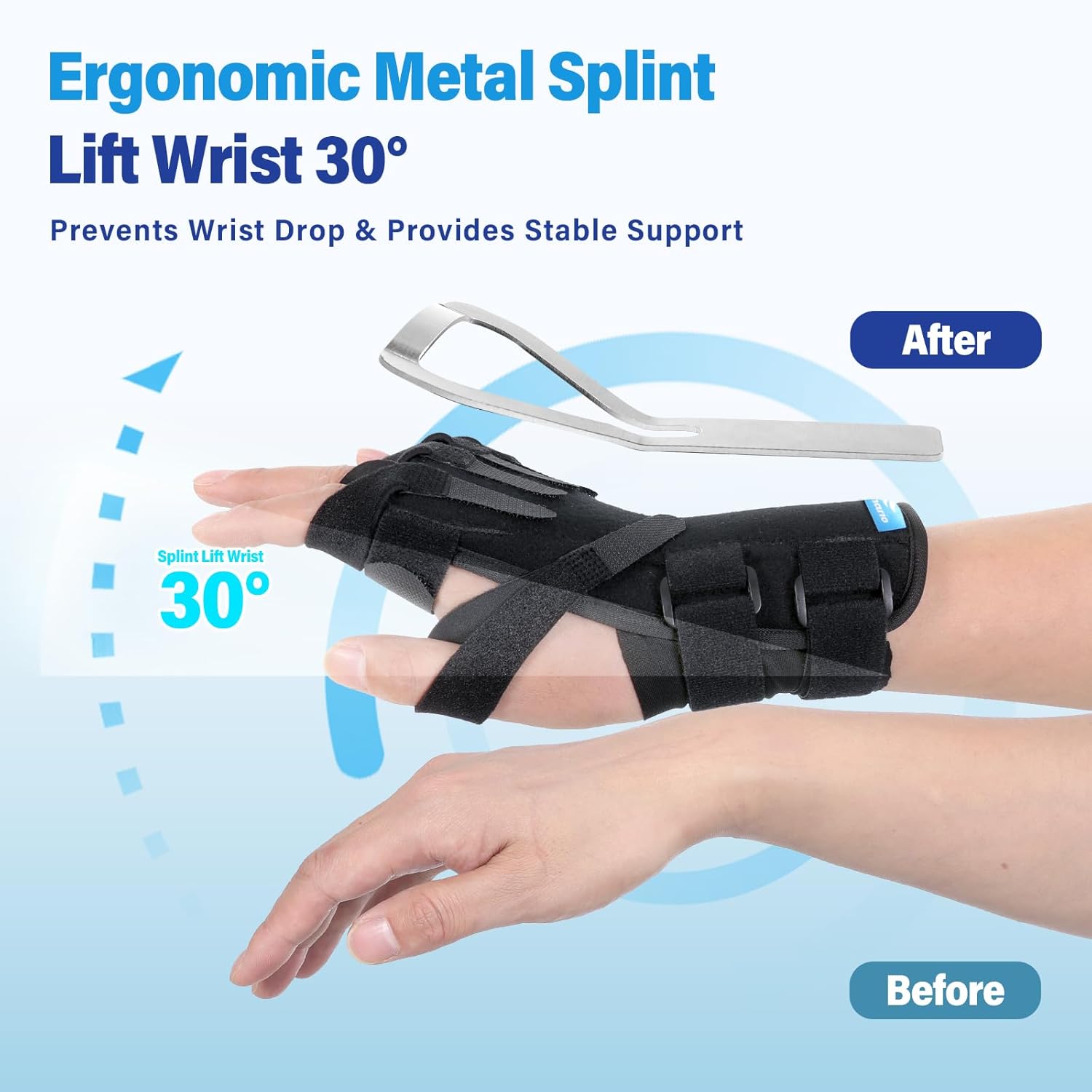Chonario Radial Nerve Palsy Splint for Wrist Drop, Finger Extension Brace

