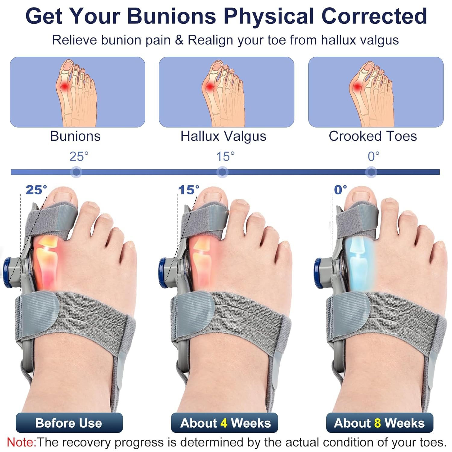 Treatmedy Adjustable Bunion Corrector for Big Toe, Orthopedic Toe Straightener Splint

