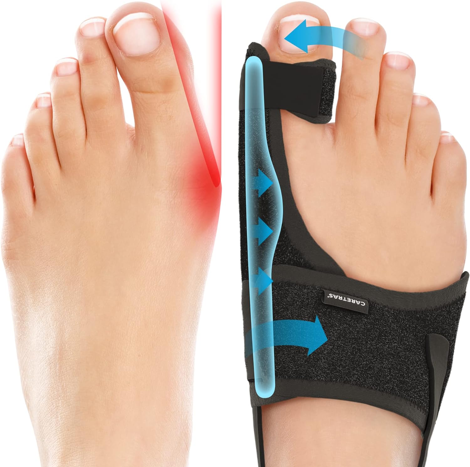 Caretras Bunion Corrector 2-Pack, Orthopedic Hallux Valgus Splint for Comfort

