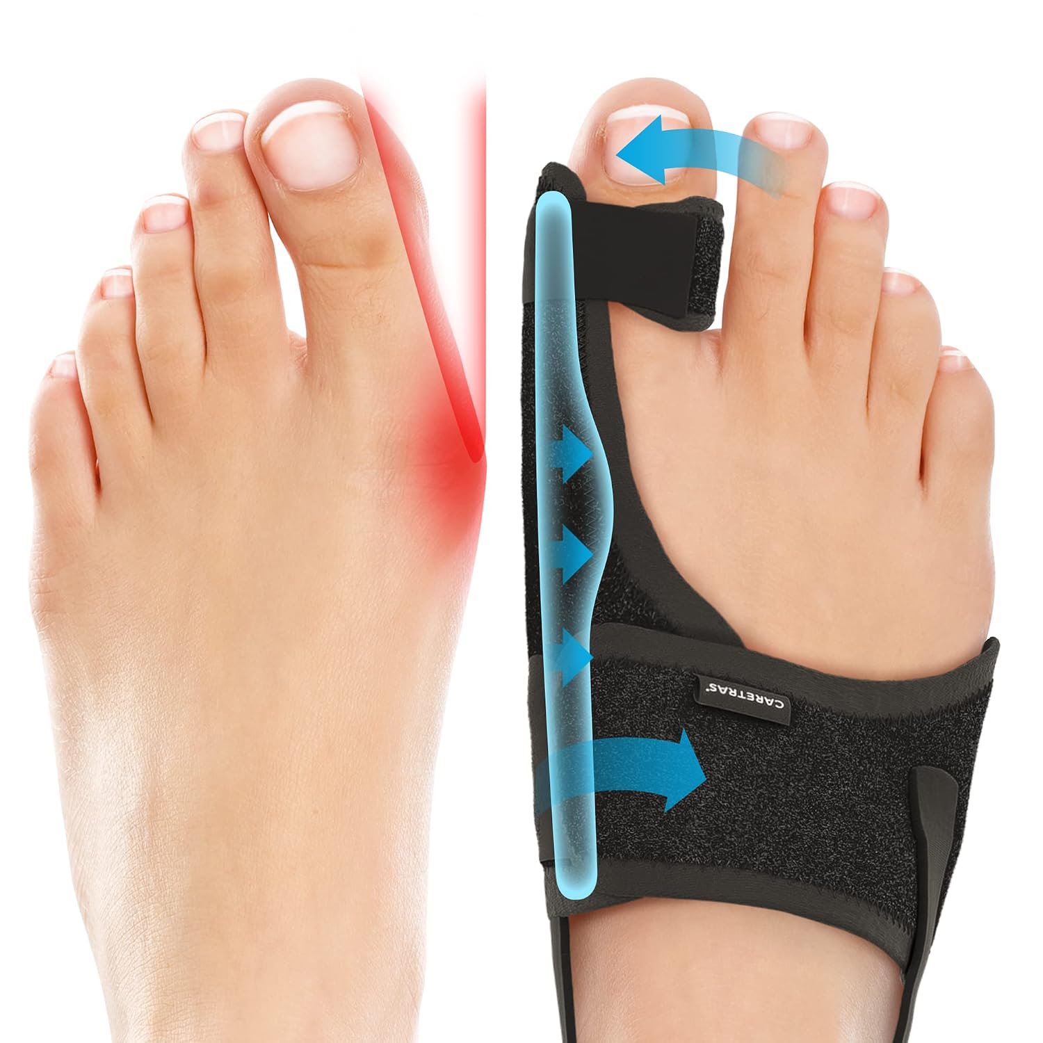 Caretras Bunion Corrector 2-Pack, Orthopedic Hallux Valgus Splint for Comfort