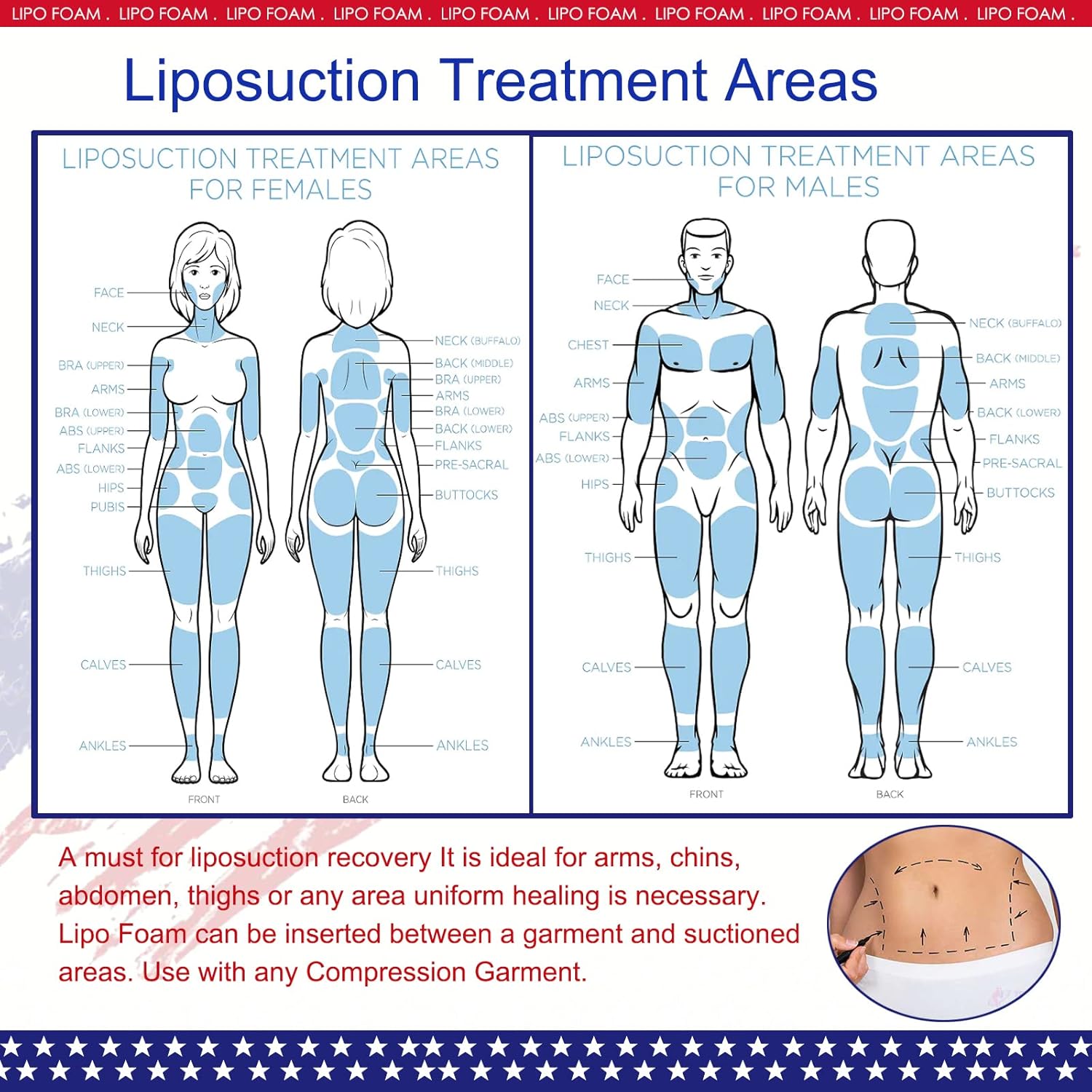 KUSMOO Post-Surgery Lipo Foam Pads for Compression Garments, Abdominal Support

